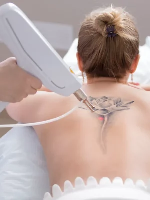 laser-services-a-at-micari-aesthetic-wellness